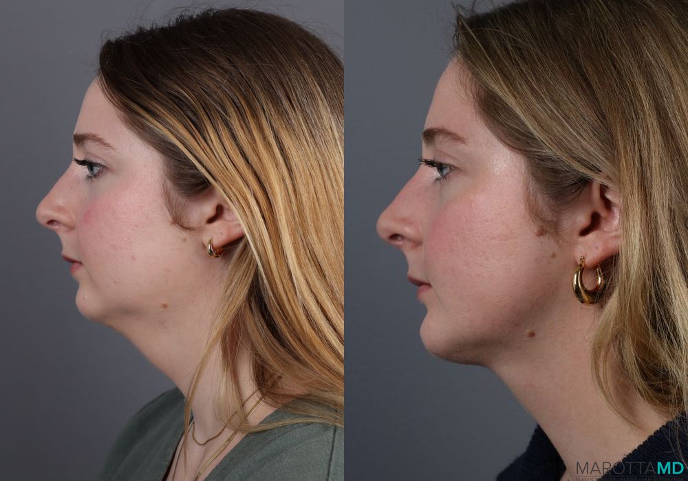 Chin Implant - Thumbnail 2