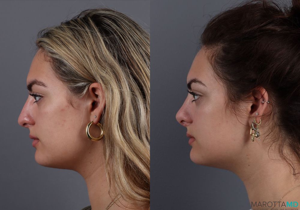 Before and after Rhinoplasty case 7250 - Angle 5