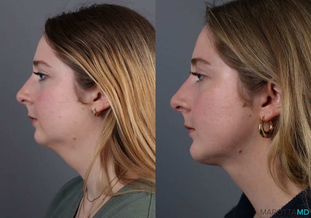 Liposuction of the Neck - Thumbnail 2