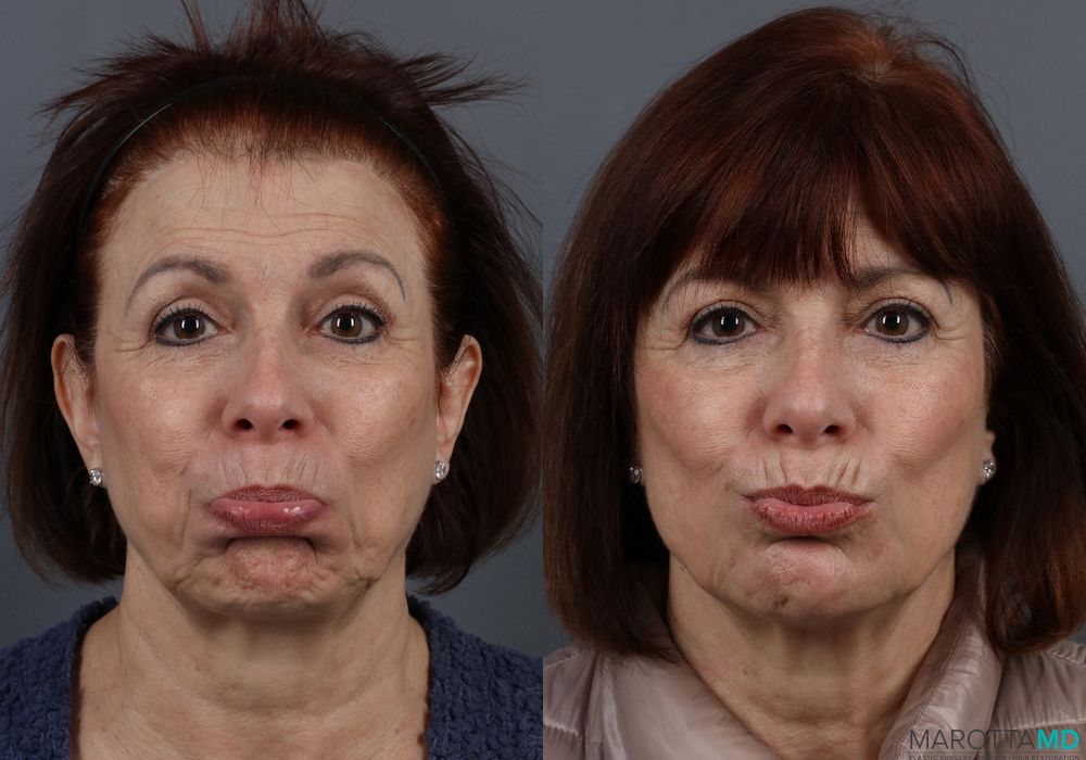 BOTOX® Cosmetic - Thumbnail 3