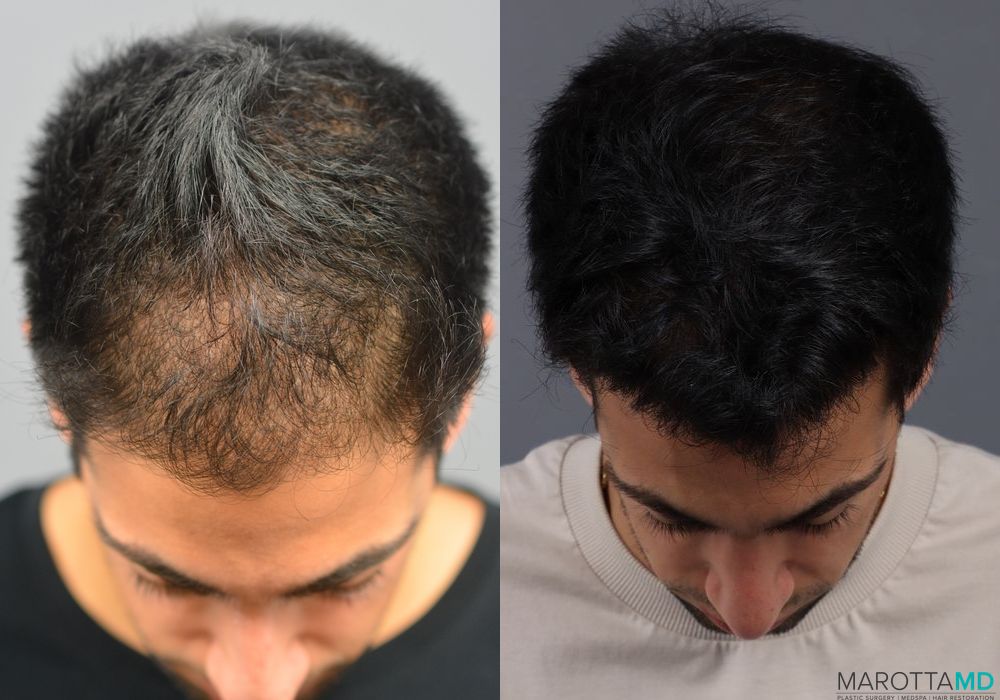 Before and after PRP Scalp Treatment case 7199