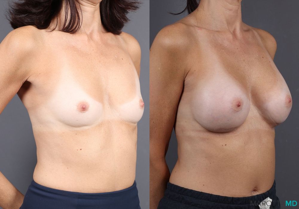 Breast Augmentation - Thumbnail 3