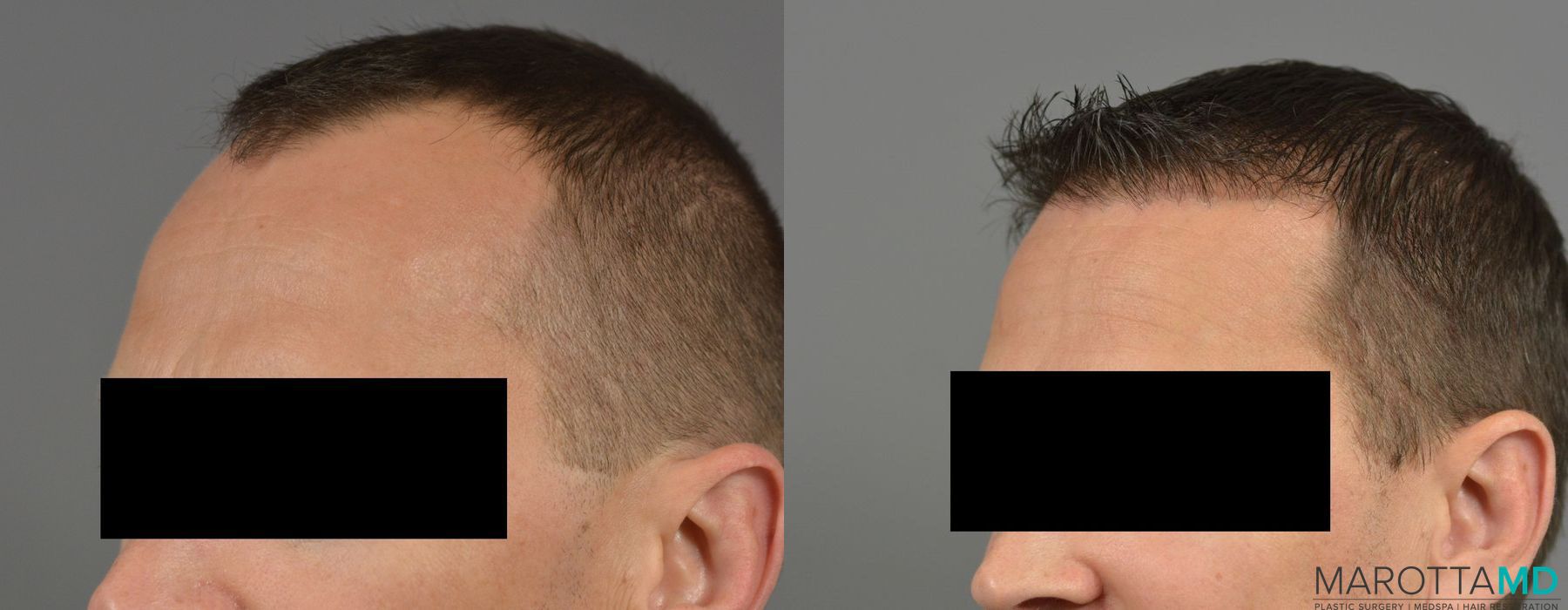 Hair Transplantation - Case 280