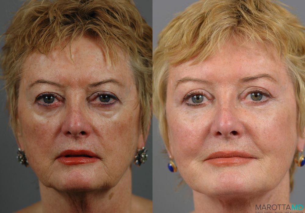Before and after Eyelid Lift case 7253