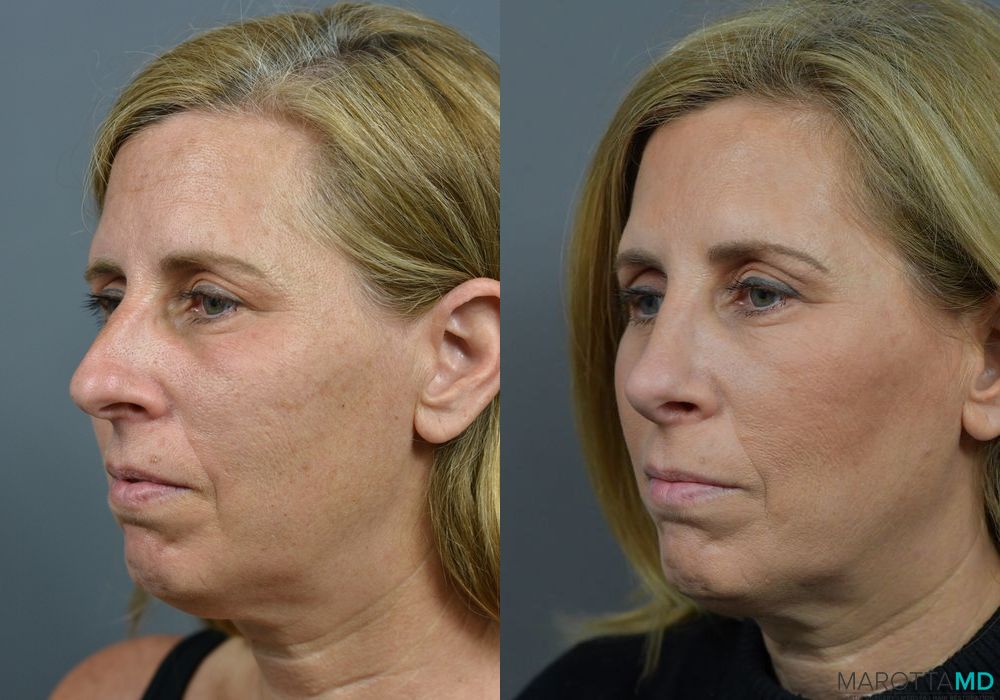 Before and after Rhinoplasty case 7203 - Angle 4
