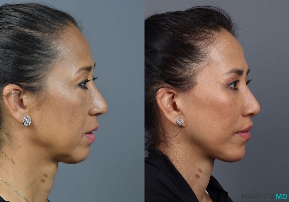 Buccal Fat Removal - Thumbnail 4