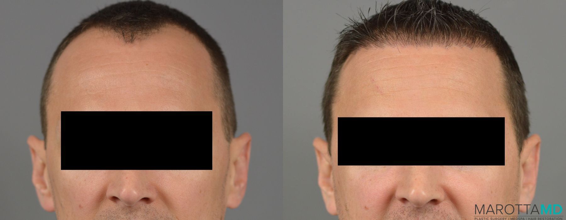 Hair Transplantation - Thumbnail 6