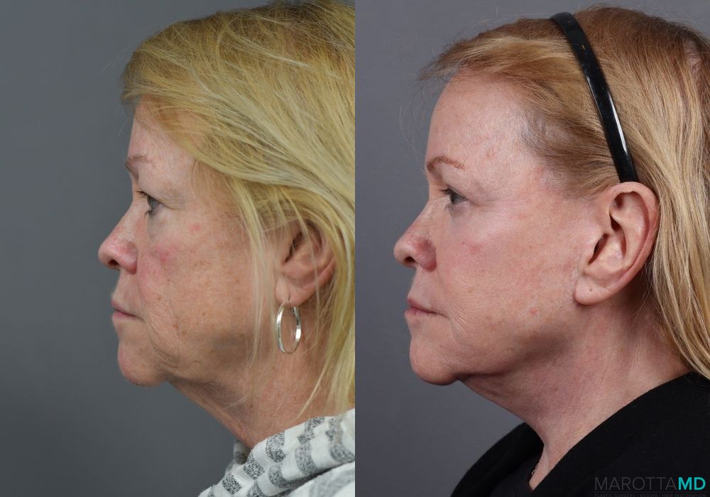 Blepharoplasty - Thumbnail 2