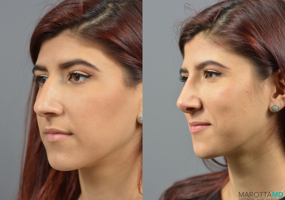 Rhinoplasty - Thumbnail 4