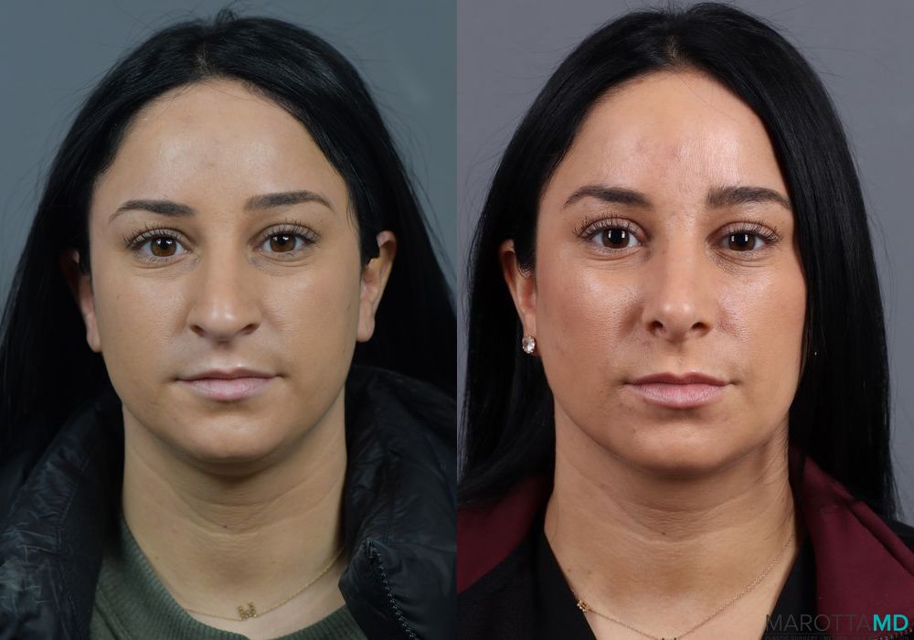 Before and after Rhinoplasty case 7229