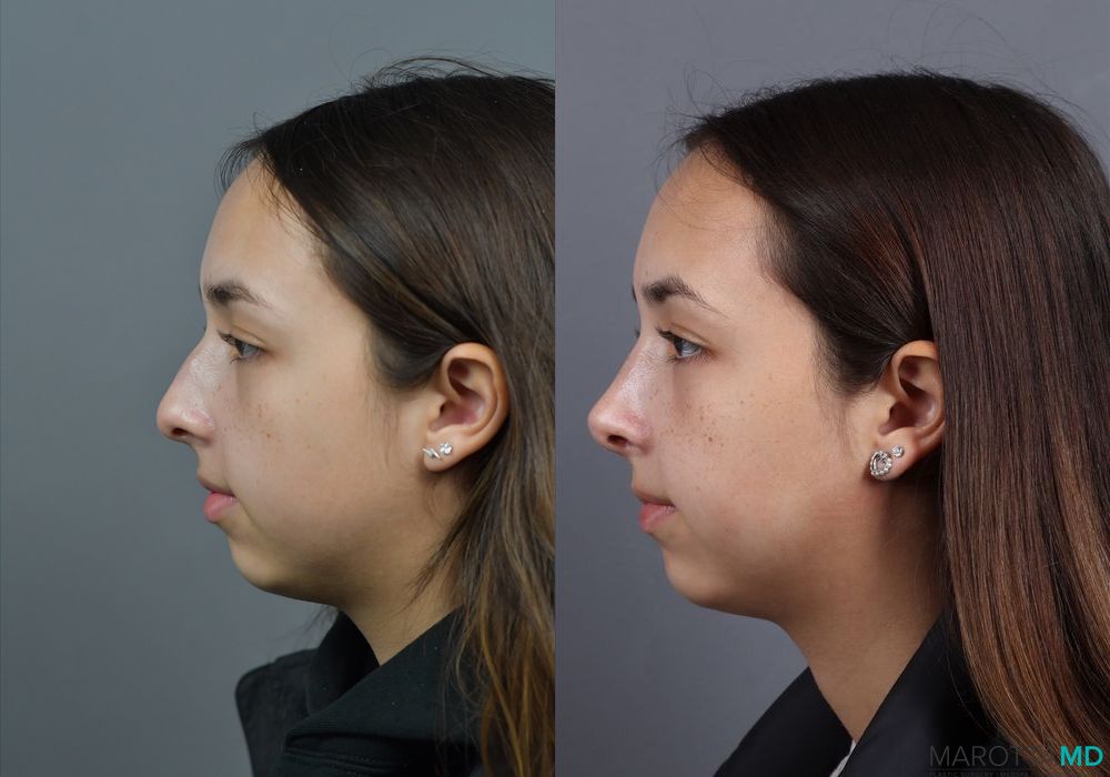Before and after Rhinoplasty case 7279 - Angle 3