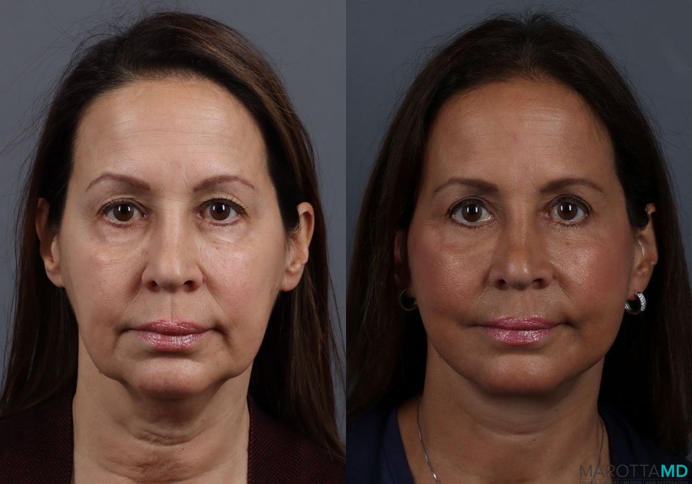 Facelift & Neck Lift - Thumbnail 5