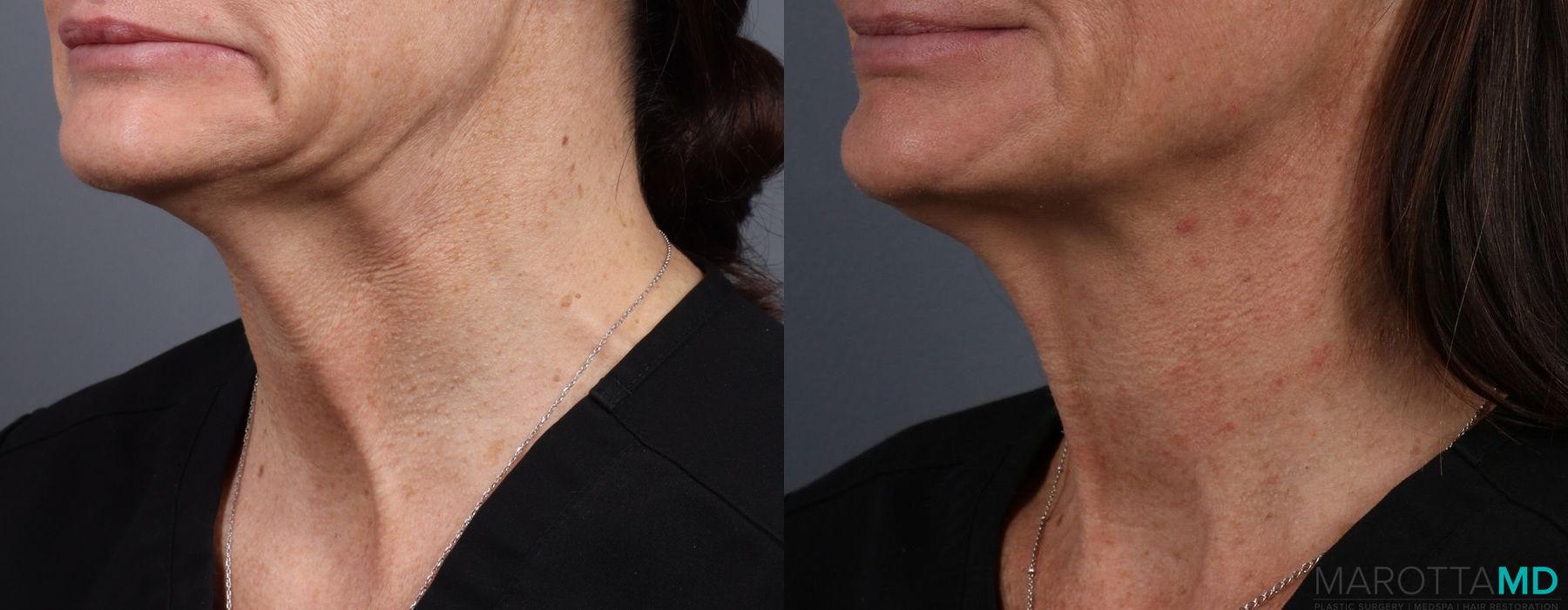 Botox - Nefertiti Neck Lift - Case 358