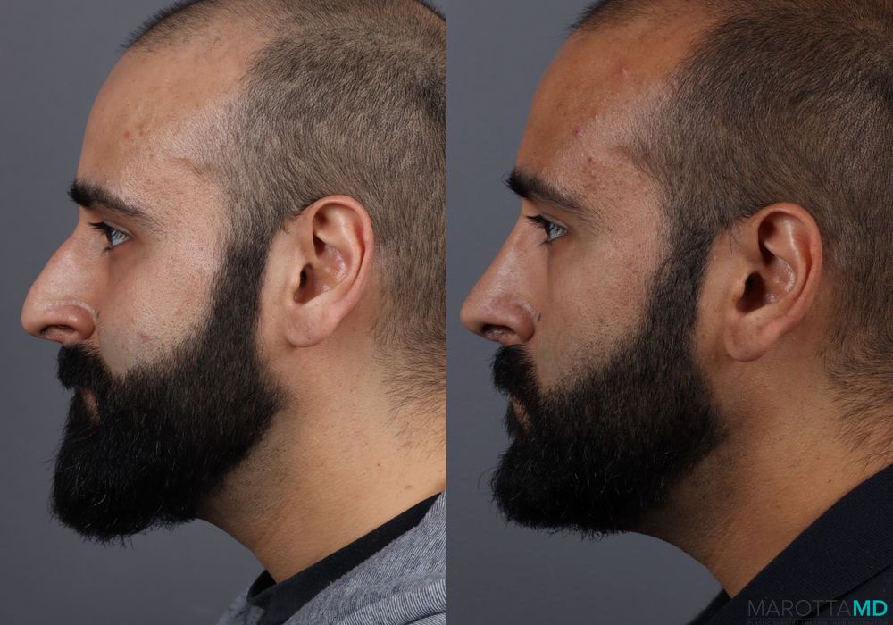 Before and after Male Rhinopolasty case 7261 - Angle 2