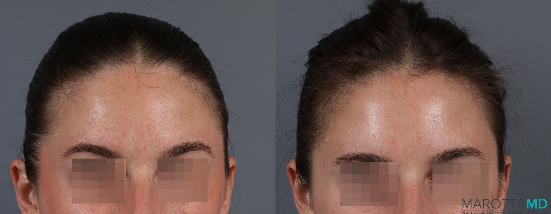 Before and after Botox - Forehead case 7189 - Angle 3