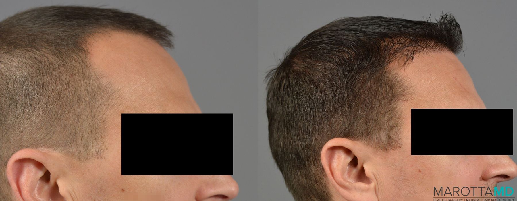 Hair Transplantation - Thumbnail 5