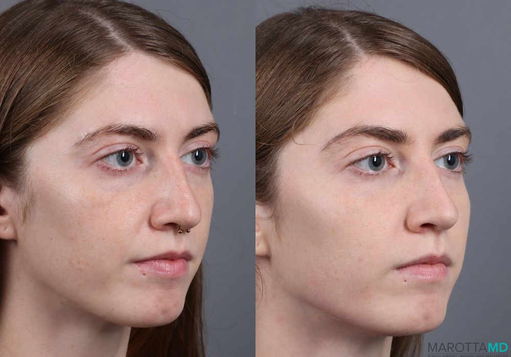 Juvederm / Fillers - Thumbnail 4