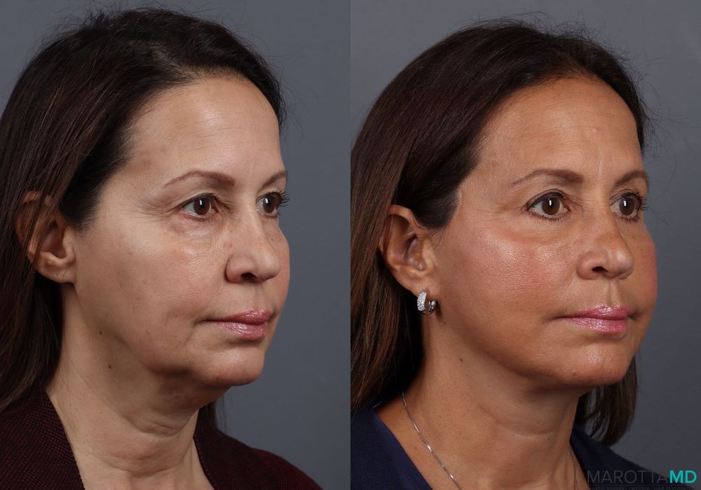 Facelift & Neck Lift - Thumbnail 4