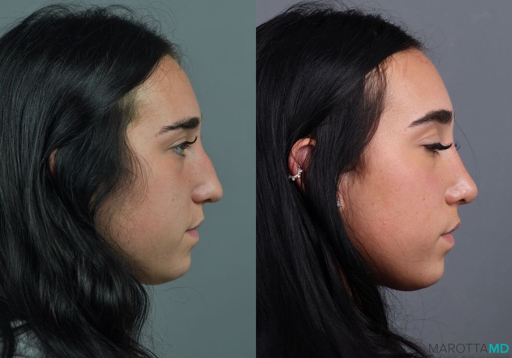Before and after Rhinoplasty case 7286 - Angle 3