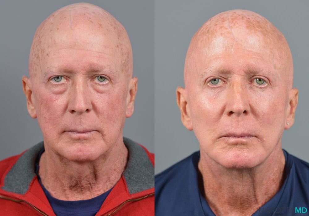 Cheek Augmentation - Thumbnail 3