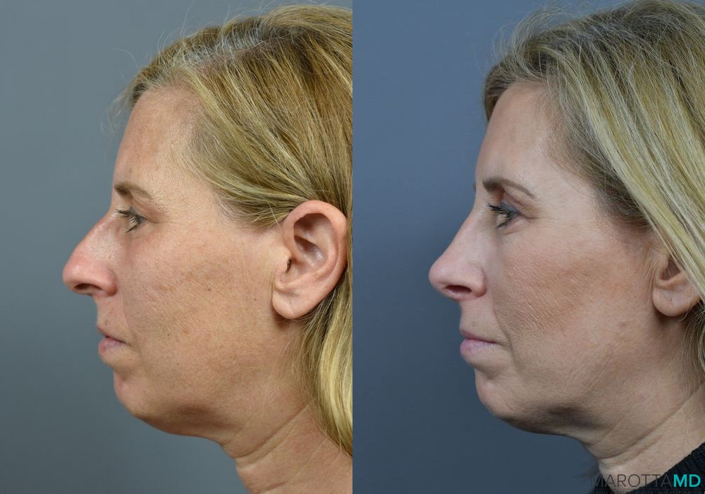 Before and after Rhinoplasty case 7203 - Angle 5