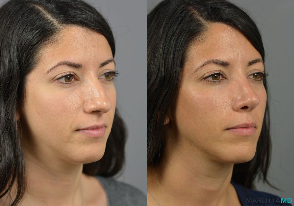 Rhinoplasty - Thumbnail 3