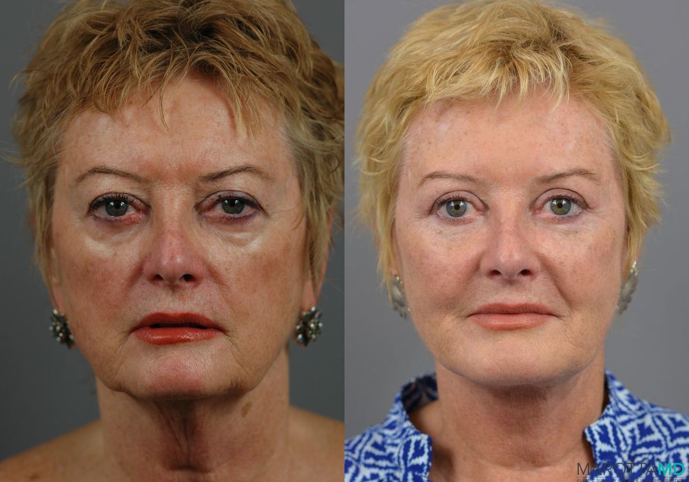 Facelift & Neck Lift - Thumbnail 5