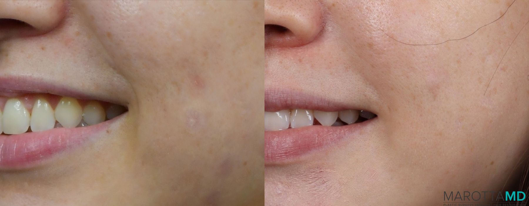 Before and after Botox - Gummy Smile case 7201 - Angle 3