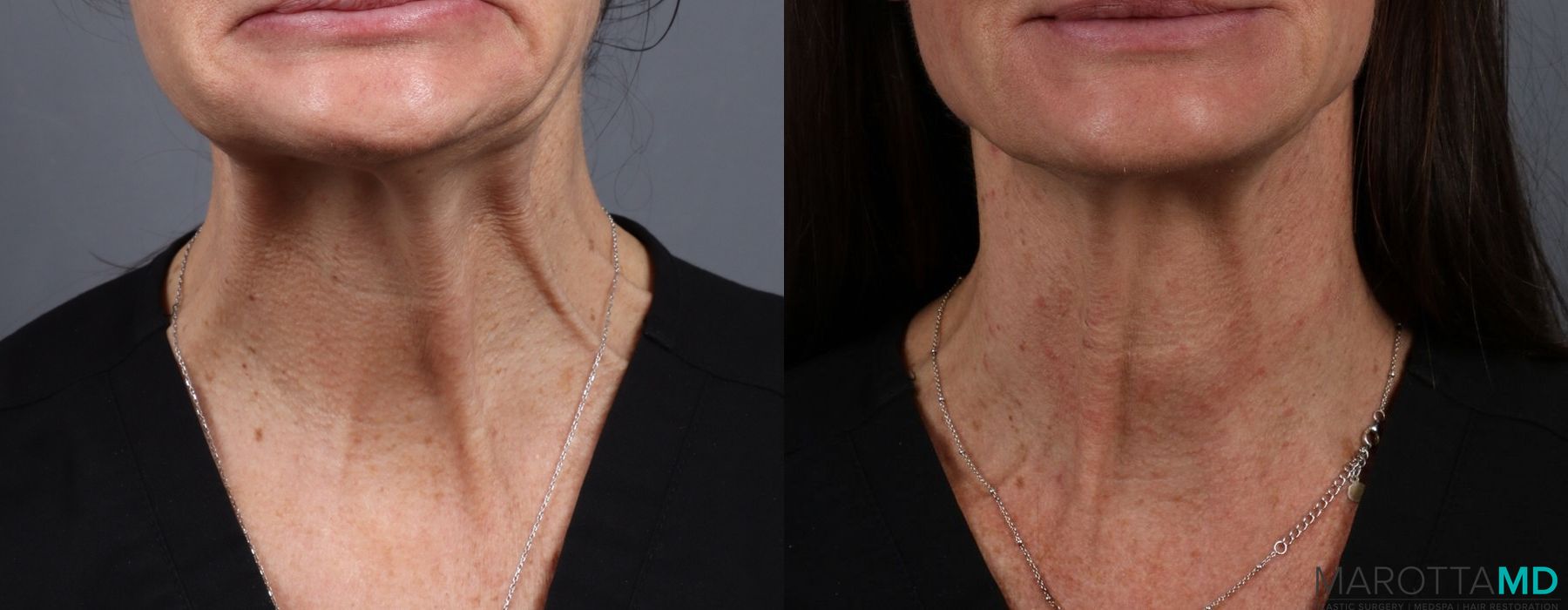 Botox - Nefertiti Neck Lift - Thumbnail 2