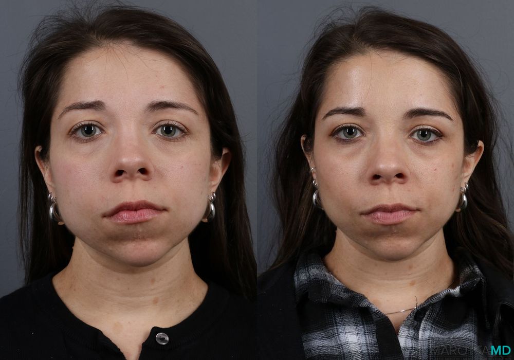 Botox - Crow's Feet - Case 298