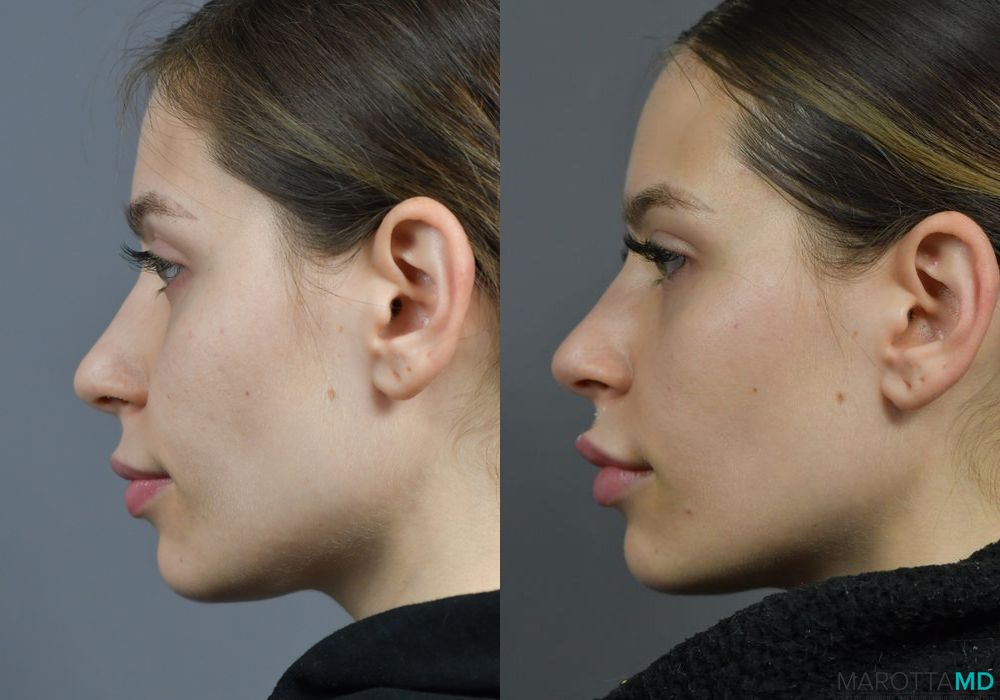 Before and after Botox - Lip Flip case 7289 - Angle 2