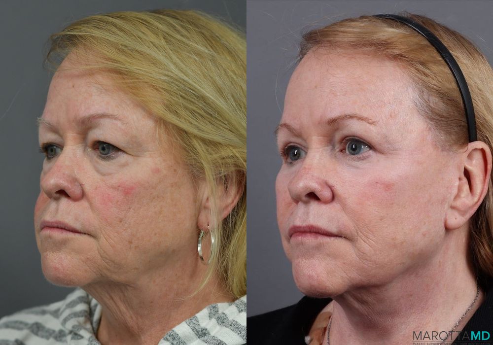 Blepharoplasty - Thumbnail 5