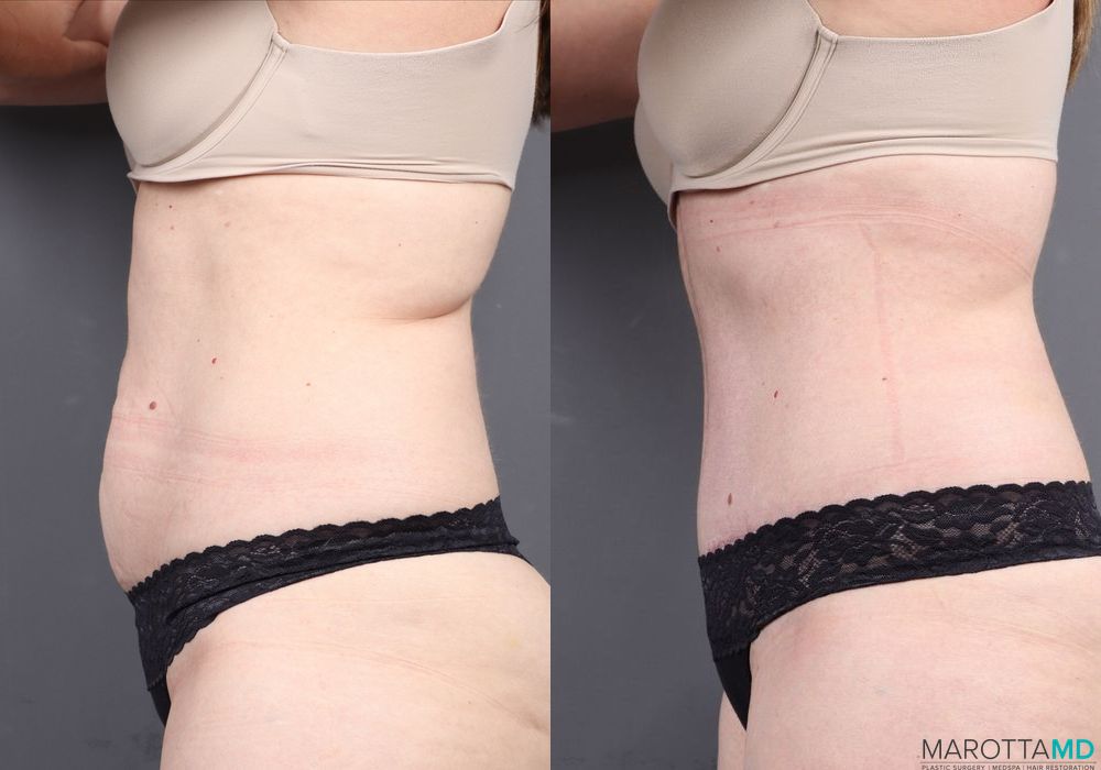 Abdominoplasty - Thumbnail 2