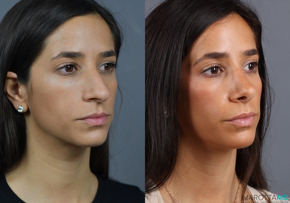 Before and after Rhinoplasty case 7278 - Angle 4