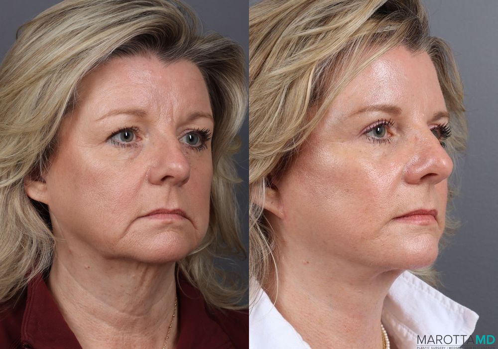Before and after Facelift & Neck Lift case 7056 - Angle 2