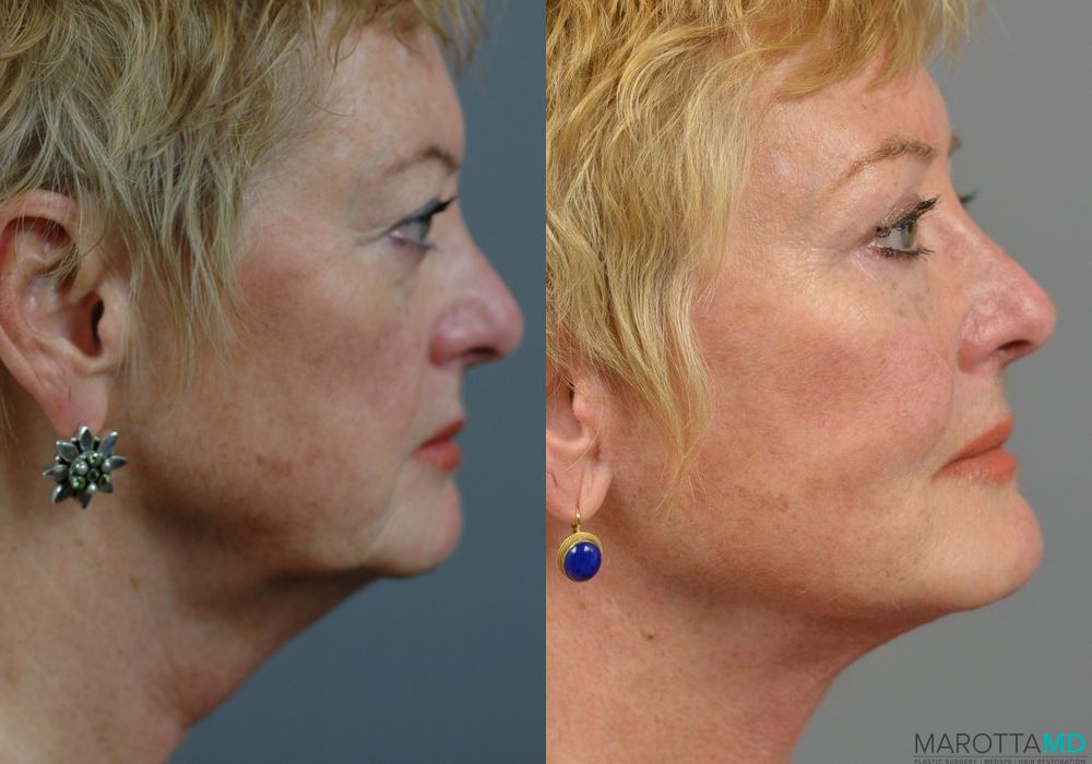 Before and after Fat Transfer - Face case 7227 - Angle 5