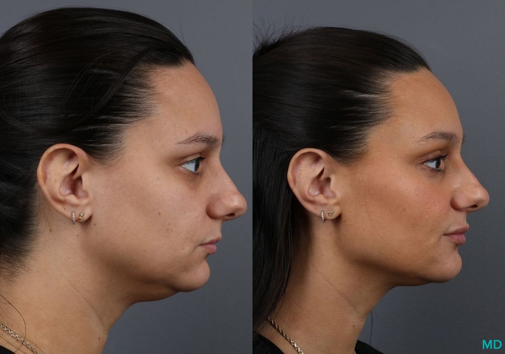Before and after Filler - Lips case 7210 - Angle 3