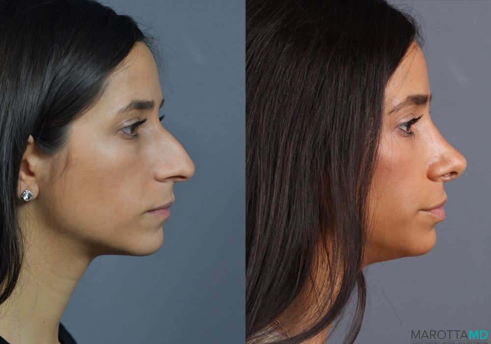 Before and after Rhinoplasty case 7278 - Angle 5