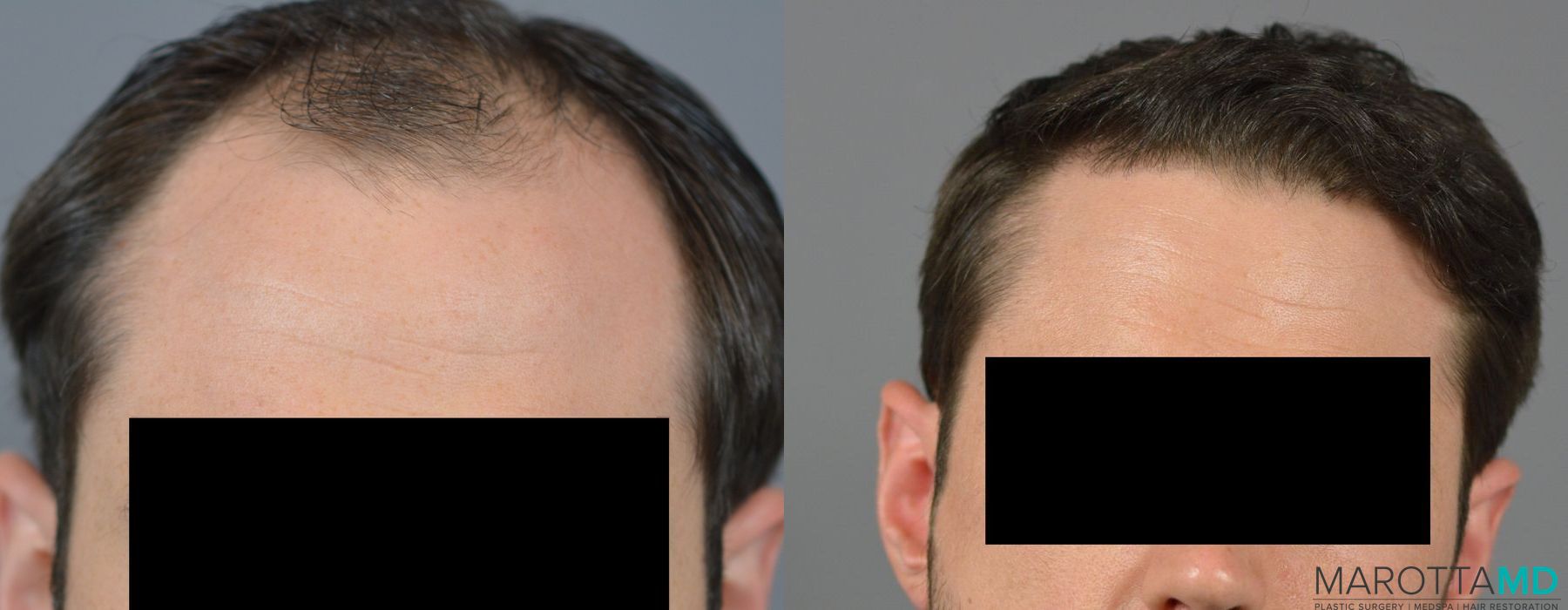 Hair Transplantation - Case 650