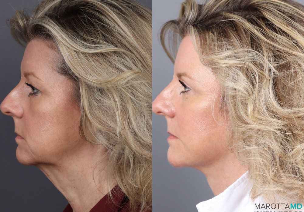 Before and after Fat Transfer - Face case 7263 - Angle 5
