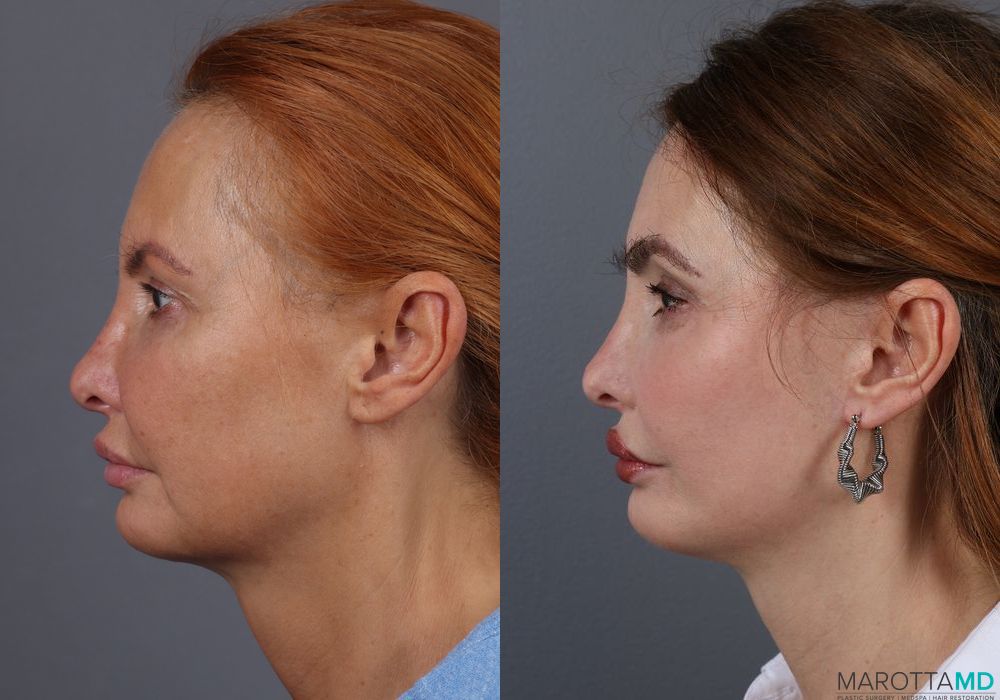 Mini Facelift - Thumbnail 5