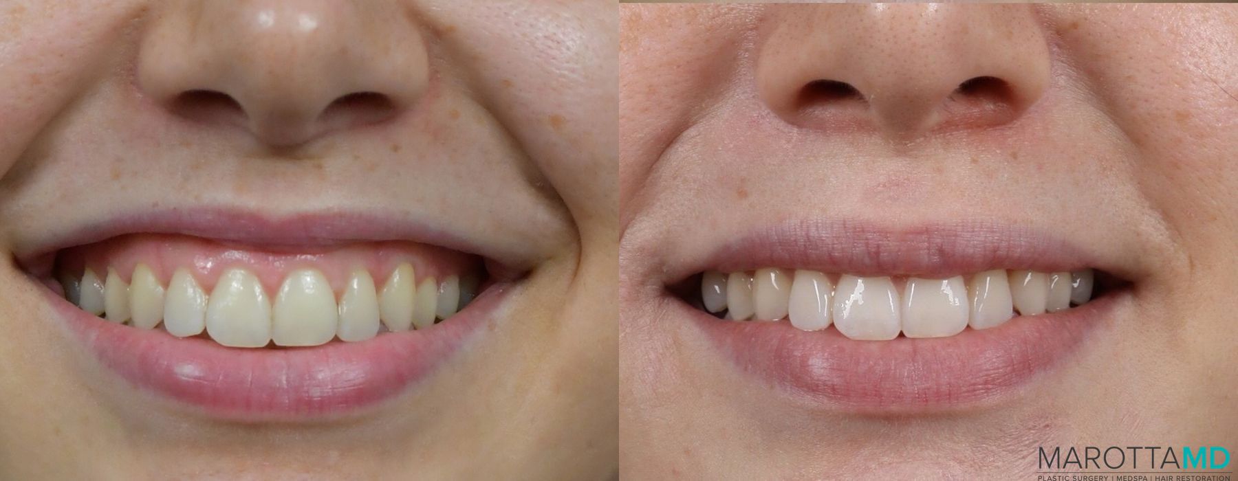 Botox - Gummy Smile - Case 352