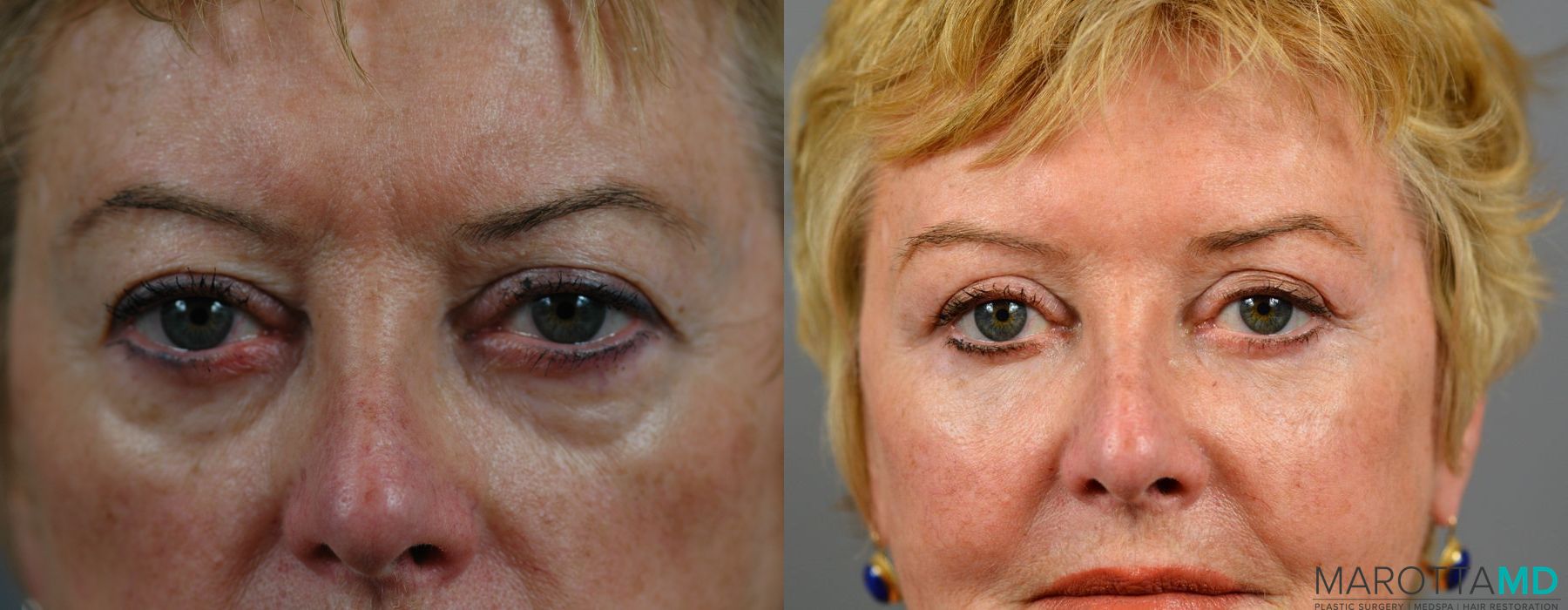 Blepharoplasty - Thumbnail 4