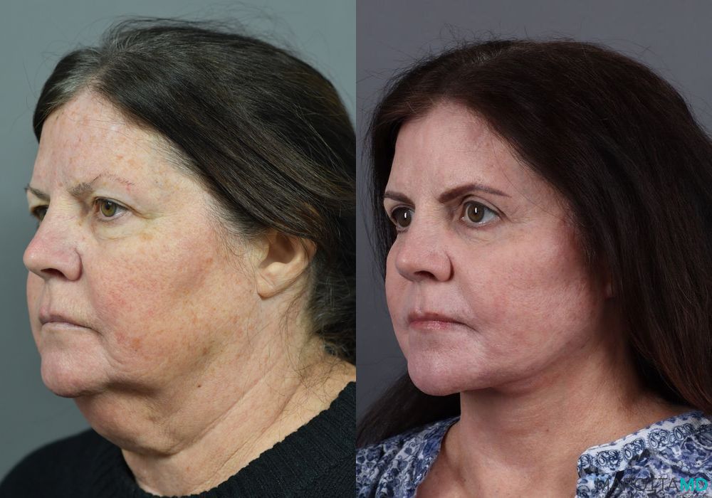 Blepharoplasty - Thumbnail 5