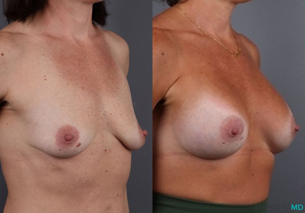 Before and after Breast Augmentation case 7083 - Angle 2