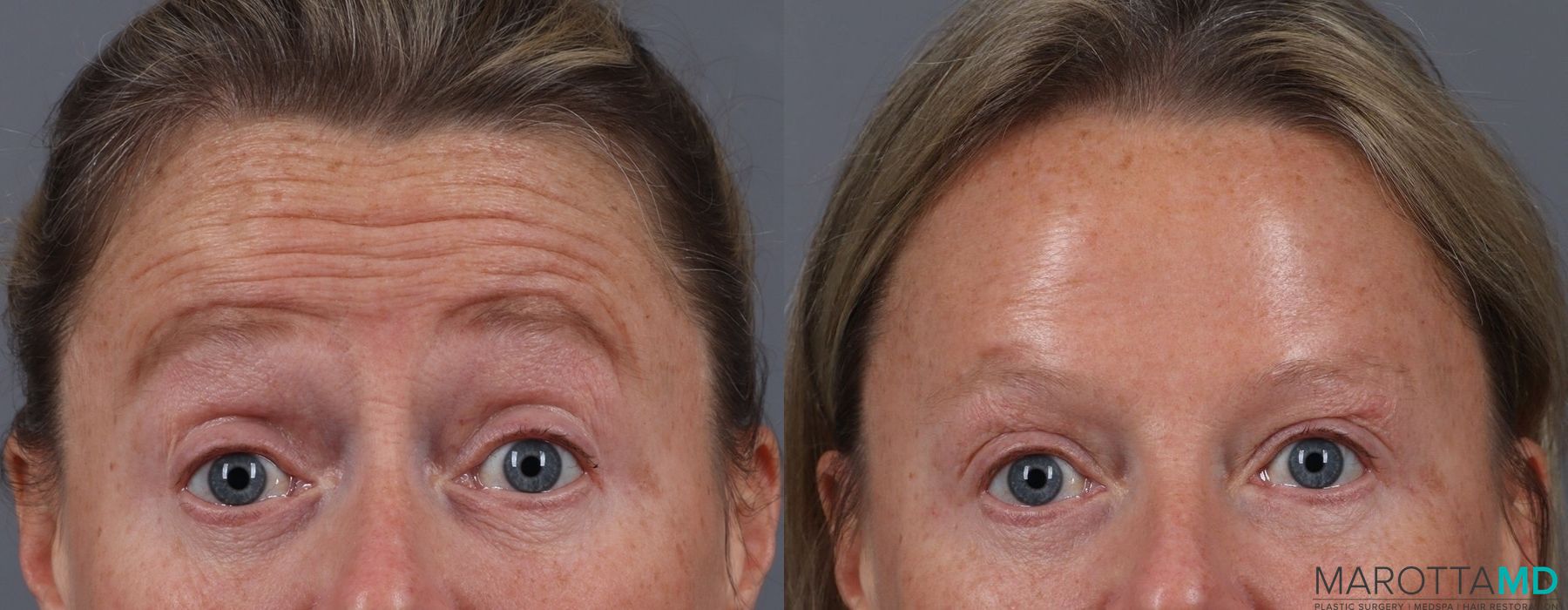 Before and after Botox - Forehead case 7128