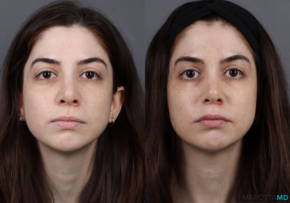 Before and after Botox - Lip Flip case 7202