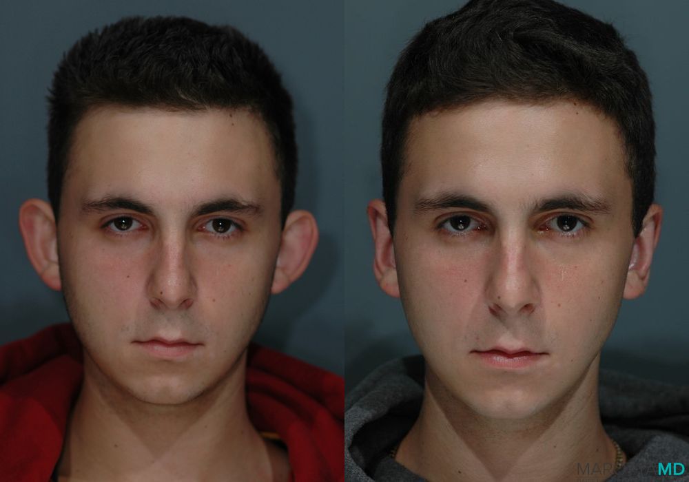 Otoplasty - Thumbnail 2