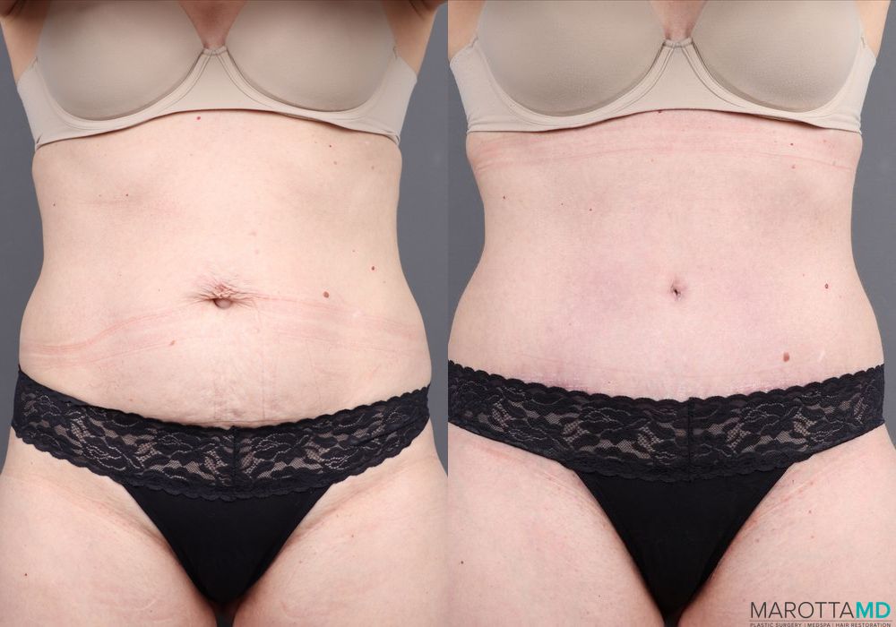 Abdominoplasty - Thumbnail 4