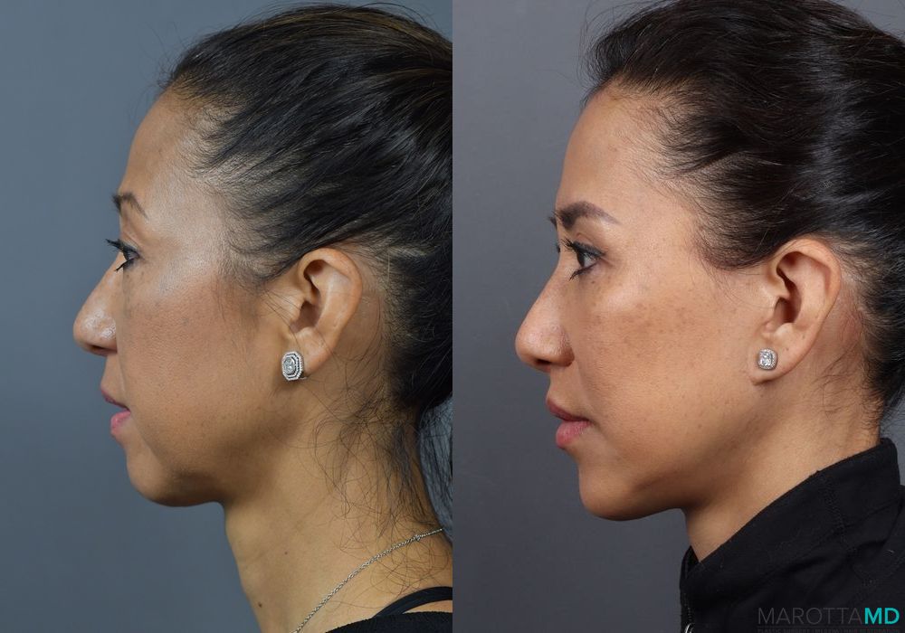 Lip Lift - Thumbnail 4